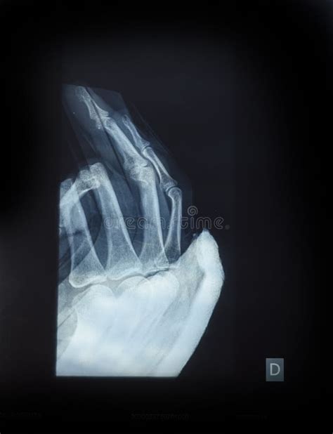 X-Ray image of human hand stock image. Image of disease - 60706123