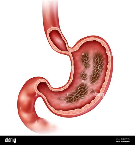 Gastritis Stomach Disease As An Inflammation Of The Inner Lining Of The