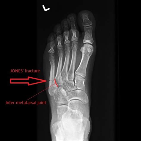 Fifth Metatarsal Fractures