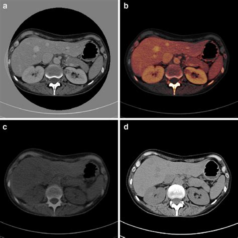 Evaluation Of A Kidney Lesion In Dual Energy Ct Window Width 350 Hu