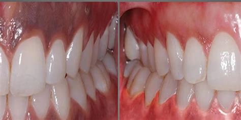 Laser Gum Depigmentation Cause Technique And Aftercare