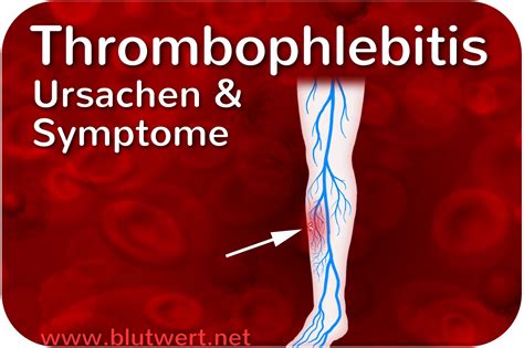 Thrombophlebitis Ursachen Und Symptome