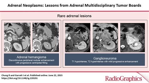 Adrenal Neoplasms Lessons From Adrenal Multidisciplinary Tumor Boards