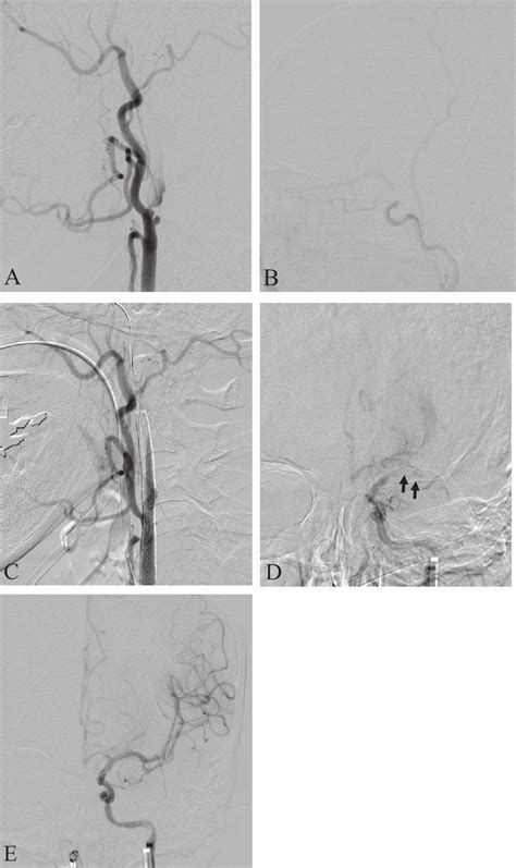 Dsa Of Left Common Carotid Artery Cca Shows Severe Stenosis At Left