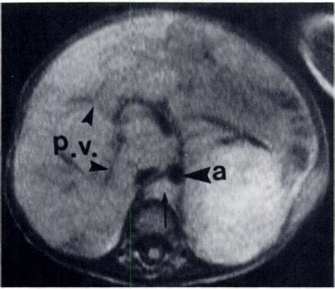 Vessel Visualization Allows Accurate Evaluation Of The Metastatic