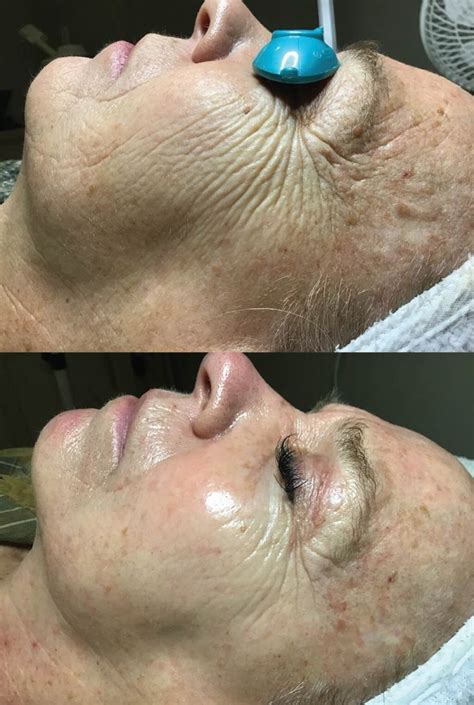 Skin Renewal Peel