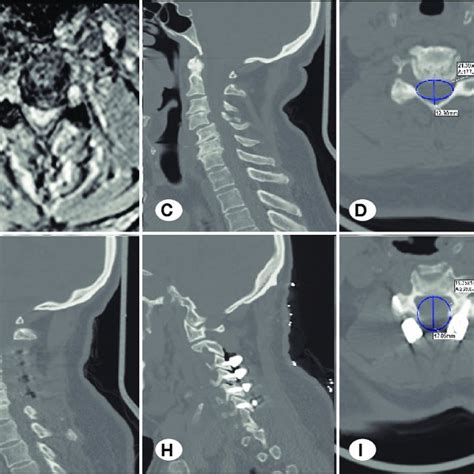 Preoperative T2w Mri A Sagittal B Axial And Ct Scan C Sagittal Download Scientific