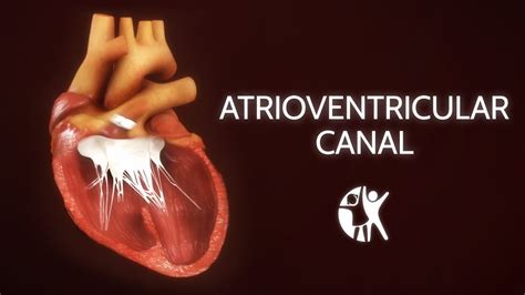 Atrioventricular Septal Defect Av Canal Youtube