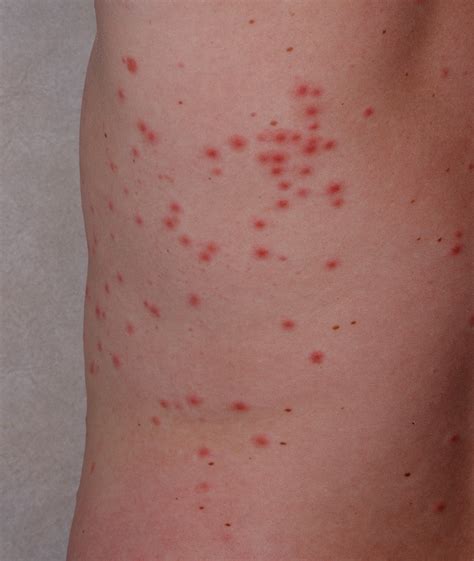 Hot Tub Folliculitis Rd