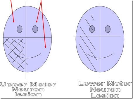 Upper motor neuron & Lower motor neuron lesions - Medatrio