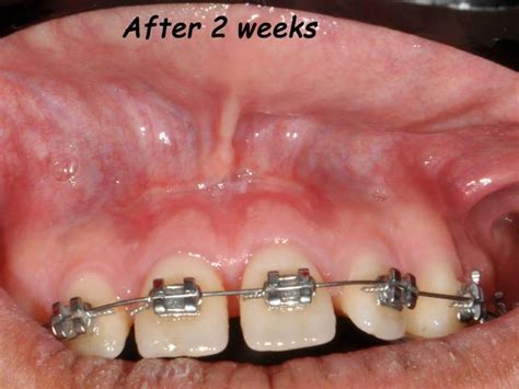 Labial Frenectomy With Ndyag Laser And Conventional Surgery