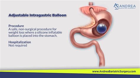 Balloon Weight Loss Surgery Blog Dandk