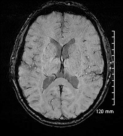 Transient Global Amnesia Image Radiopaedia Org