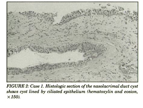 Neonatal Dacryocystitis Associated With Nasolacrimal Duct Cysts