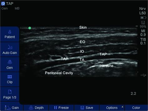 Ultrasound Guided Transversus Abdominis Plane Block Anesthesia Key