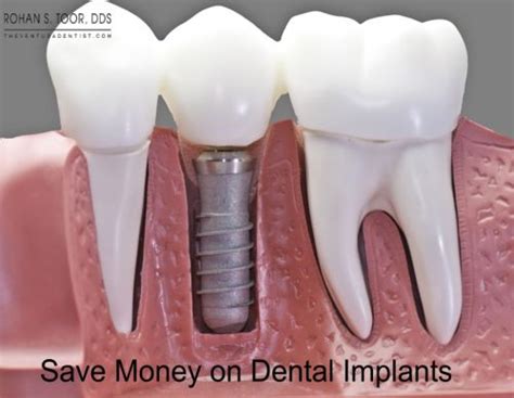ways  pay  dental implants rohan toor dental care