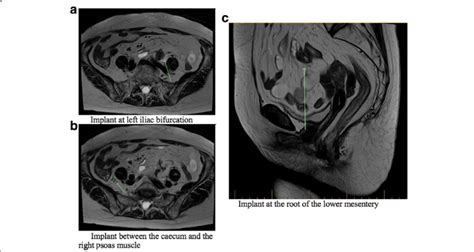 Mri Axial And Sagittal Images Showcasing The Peritoneal Carcinomatosis