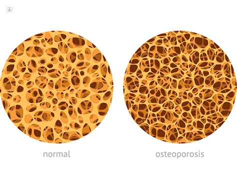 Artrosis Osteoporosis Y Artritis Top Doctors