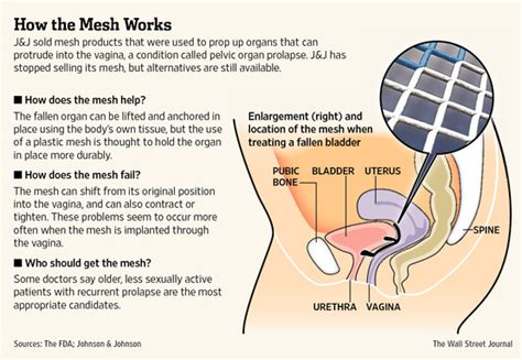 Transvaginal Mesh Dangers For Stress Incontinence Life