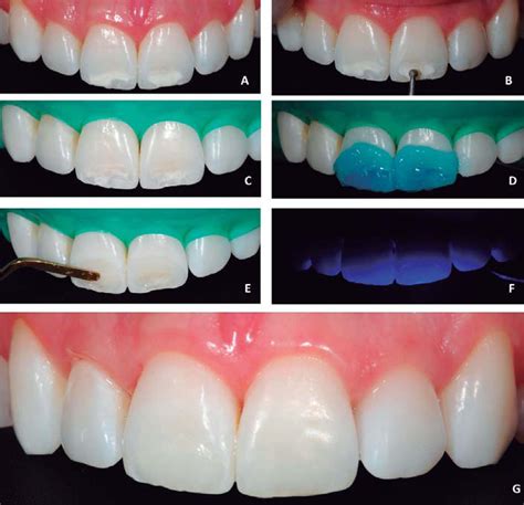 SciELO Brazil Microabrasion In Tooth Enamel Discoloration Defects