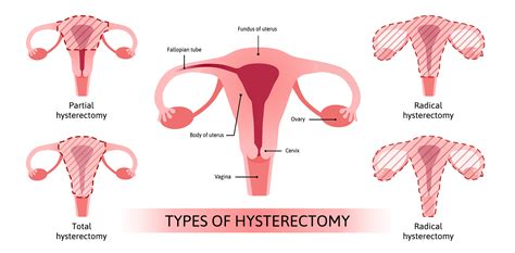 Is A Hysterectomy An Outpatient Surgery Embosseddesigns | Sexiz Pix