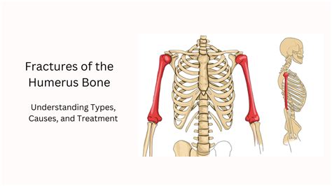 Fractures Of The Humerus Bone Understanding Types Causes And