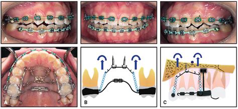 Effective Vertical Control Of The Entire Maxillary Arch With A Palatal