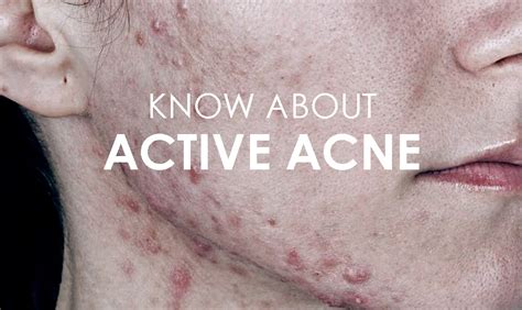 Active Acne Vulgaris Everything You Need To Know Premier Clinic