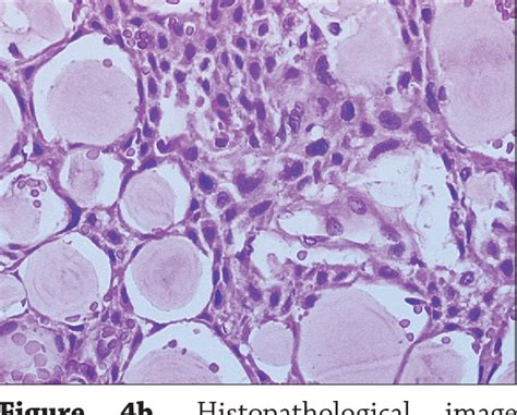 Calcifying Epithelial Odontogenic Tumor Histology