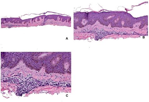 Histologic Findings Of Hypereosinophilic Syndrome In Patient 1 A B