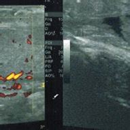 Scrotal Ultrasound Showing Hypervascular Hypoechogene Testicular Module