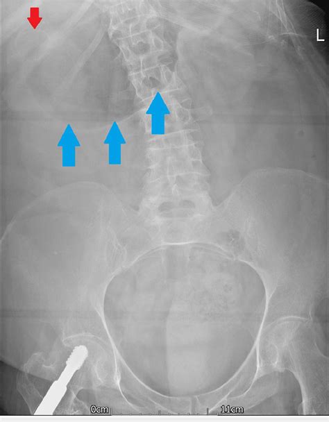 Abdominal X Ray With Distended Gastric Outline Blue Arrows Download Scientific Diagram