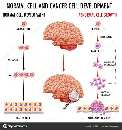 Diagram Showing Human Brain Cancer Illustration Stock Vector Image By ©interactimages 557156808