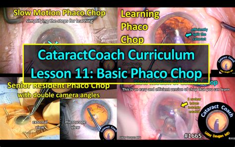 Phaco Chop Cataract Coach™