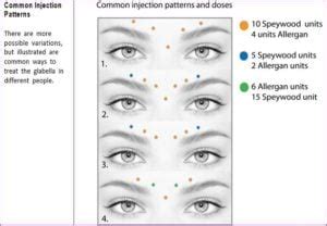 Top 3 BOTOX Injection Patterns Markup SkinViva Training