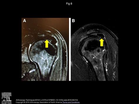 Management Of Rotator Cuff Defects After Calcific Tendinopathy