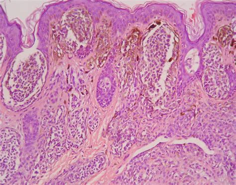 Dermatopatologia Para Iniciantes Nevos MelanocÍticos Usuais