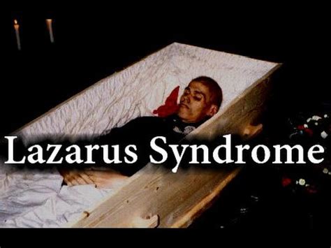 Odpowiedź na pozew: Lazarus syndrome