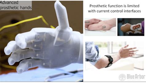 获fda突破性认可！新型神经肌肉接口arbor系统假肢