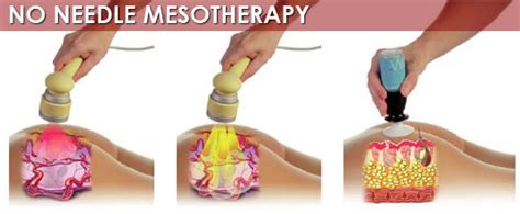 Benefits Of Mesotherapy South Africa Dr Bhabha Aesthetics