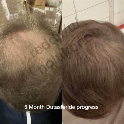 5 Month Dutasteride Progress Before And After Tressless