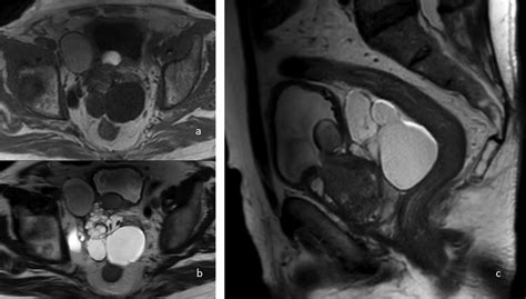 Multi Parametric Magnetic Resonance Imaging Mpmri Of The Pelvis