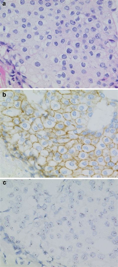 Comparison Of Dual Color In Situ Hybridization And Fluorescence In Situ