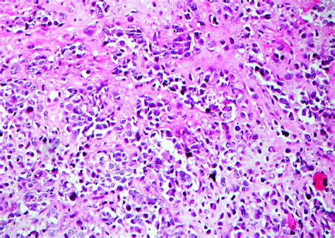 Poorly Differentiated Invasive Ductal Carcinoma With Sarcomatous