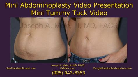 Mini Tummy Tuck Video Mini Abdominoplasty Sf Bay Area Youtube