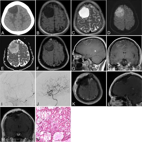 Type 2 Microcystic Meningioma Computed Tomography A Showing A Download Scientific Diagram