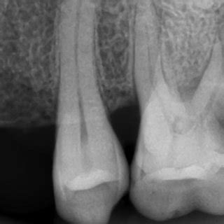 initial radiograph   left maxillary  molar