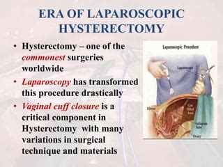 Vaginal Vault Suturing In TLH PPT