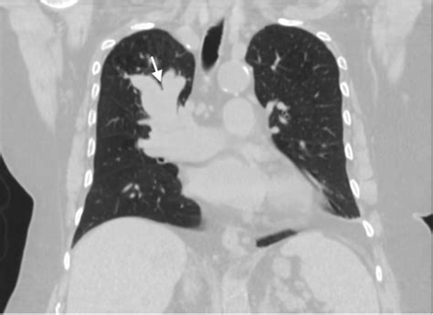 Computed tomography of the chest CT chest shows mass like enlargement ...