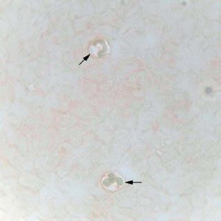 ACP. Arrows, ACP-negative neutrophils. | Download Scientific Diagram